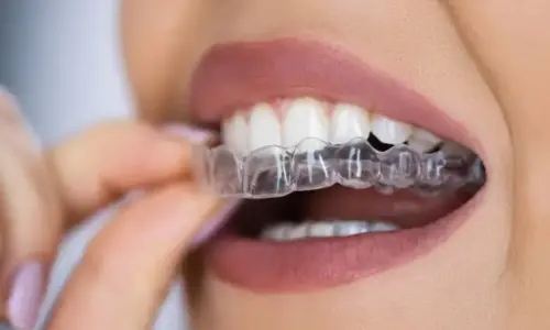 Braces & Aligners