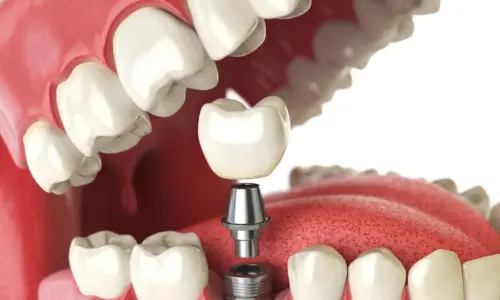Dental Implants