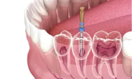 Root Canal